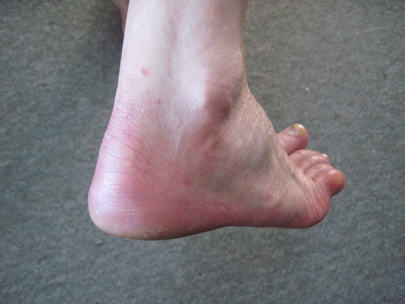 rash foot